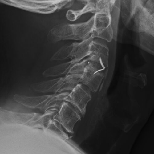 前頸椎融合手術