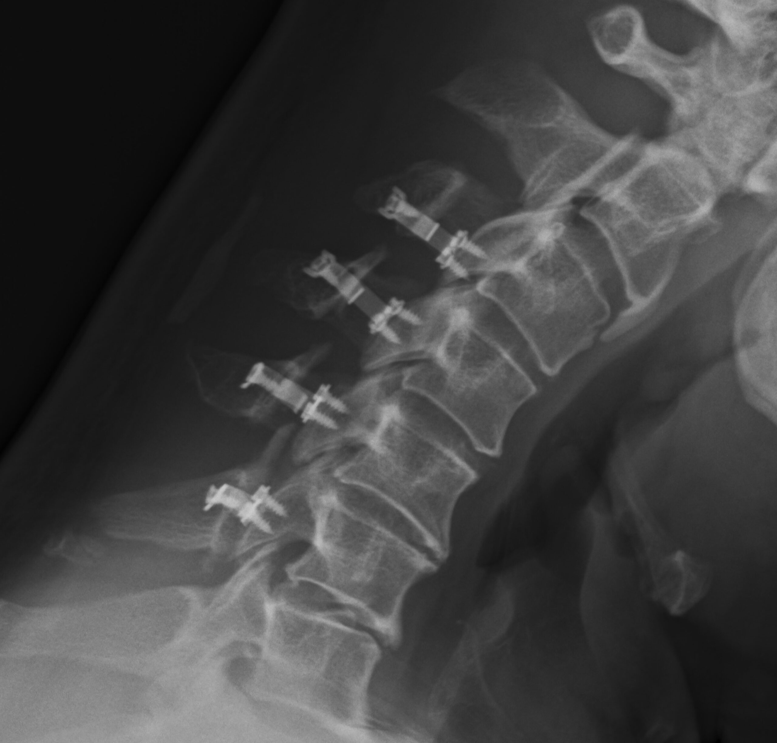 頸椎椎管擴闊手術